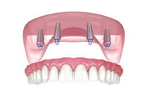 Implant Over Denture